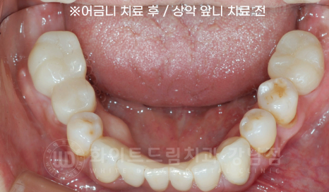 서초동 치과 추천 / "임플란트 개수를 줄이는 식립 방법은?" 강남 화이트드림치과 임플란트 관련 이미지 10