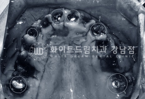 40대 전체임플란트 / 디지털스캔바디를 이용한 전체 임플란트 치료 사례 (Feat. 치주염) 관련 이미지 16