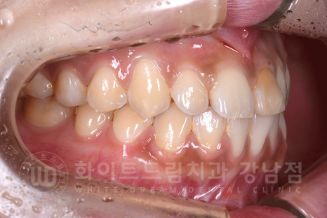 강남역 주변 치과 "10년 된 앞니가 변색됐어요" 앞니 심미 치료 관련 이미지 4