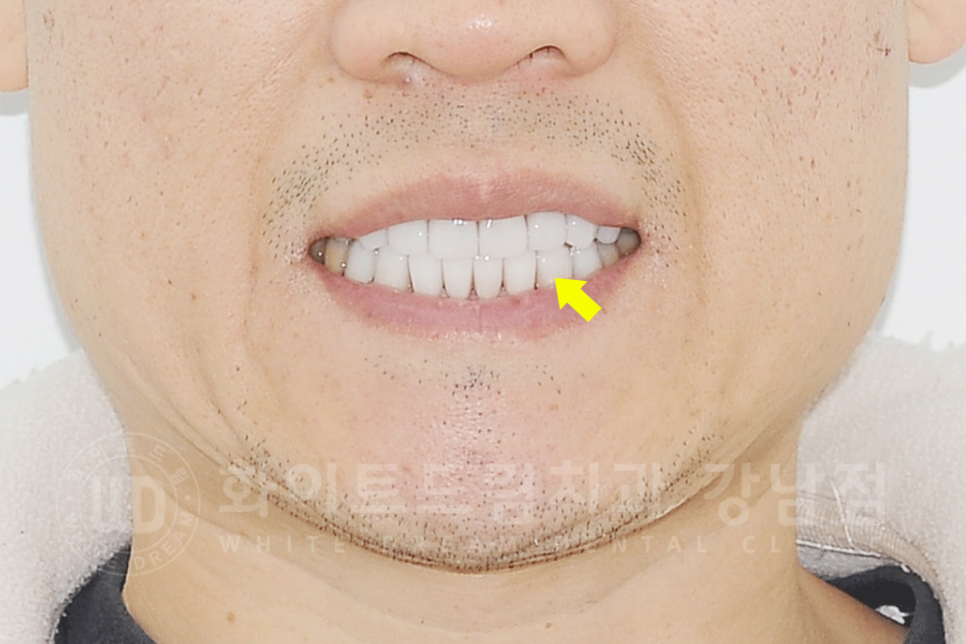 강남역 인근 치과 / 테트라사이클린(tetracycline) 치아 변색 / 라미네이트로 개선! 관련 이미지 6