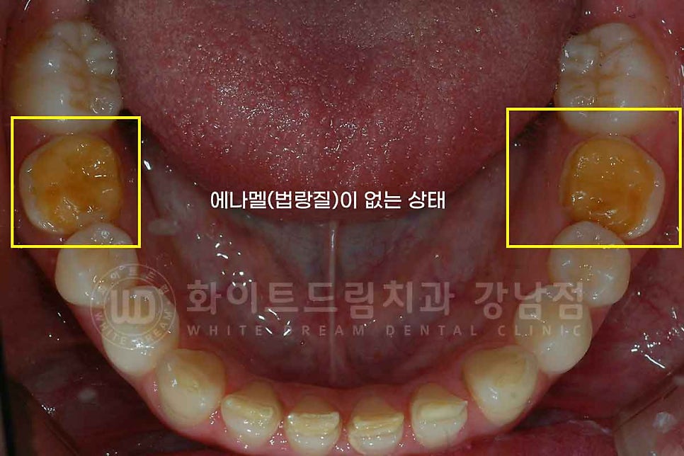 법랑질형성부전증, 라미네이트로 개선해요! / 강남역 라미네이트 치과 관련 이미지 5