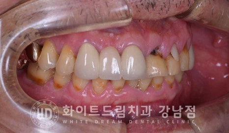 앞니 충치 라미네이트 치료 / "옆 크라운과 치아 색상을 맞추고 싶어요" 관련 이미지 7