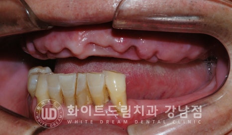 상악 풀케이스임플란트 사례 / "지인 추천으로 인천에서 왔어요." 관련 이미지 18