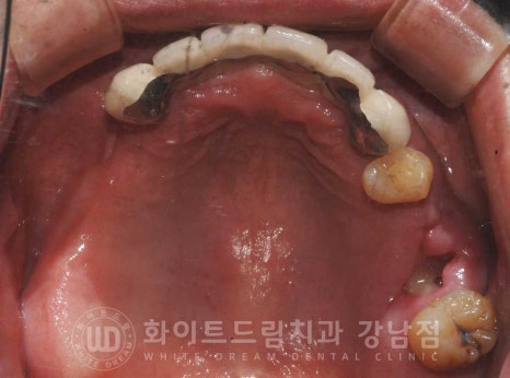 치주염 전체임플란트 치료 사례 / 치아를 흔들리게 만드는 치주염이란? 관련 이미지 5