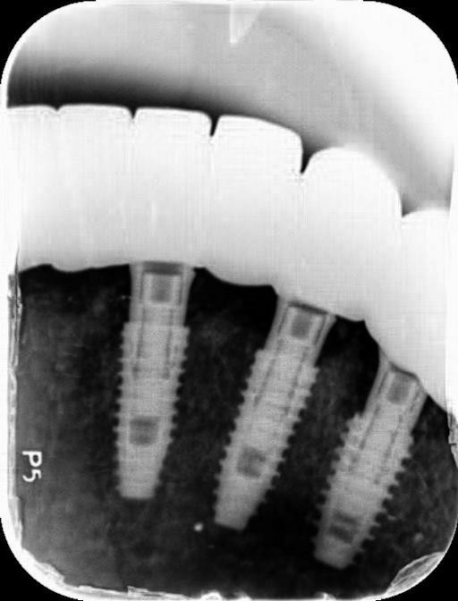 40대 전악 임플란트 식립 증례 관련 이미지 5