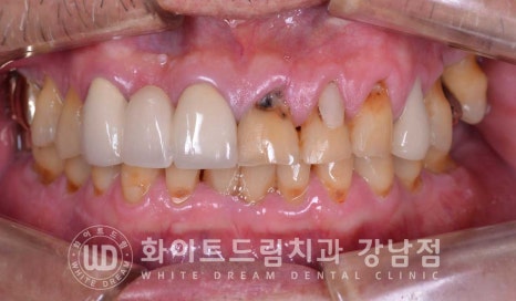 앞니 충치 라미네이트 치료 / "옆 크라운과 치아 색상을 맞추고 싶어요" 관련 이미지 2