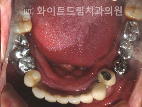 서울전체임플란트잘하는치과, 왜 치주염이 심해지면 반대교합까지 생길까요? (치주염 전체 임플란트 CASE) 관련 이미지 19