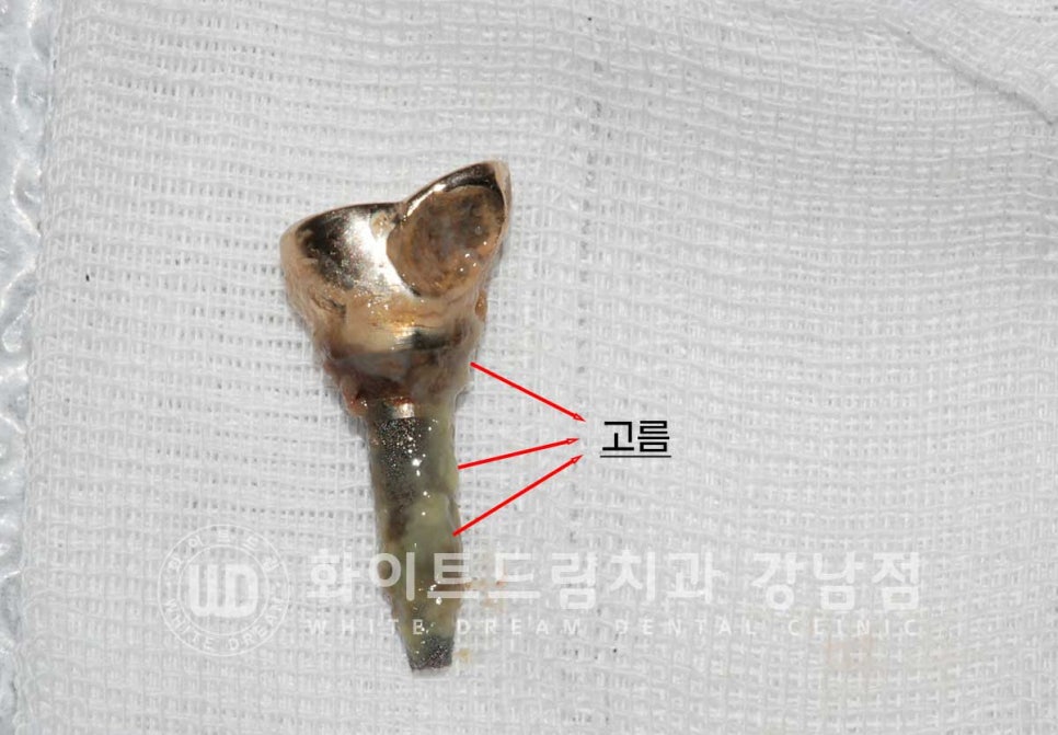 강남역 임플란트재수술 치과 / "임플란트가 흔들려요!" 임플란트 주위염 관련 이미지 7