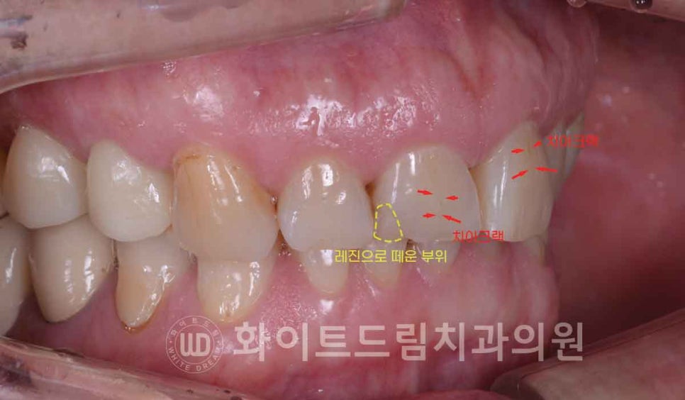 신논현역 당일 라미네이트, "길이가 다른 깨진 앞니" 당일 앞니 라미네이트 치료 과정은? 관련 이미지 5