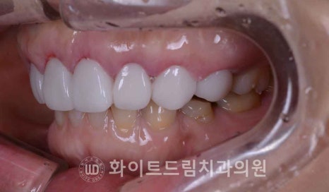 강남옹니라미네이트 "치아가 안으로 들어가서 할머니처럼 보여요" 경미 & 중증도 옹니 라미네이트 치료 관련 이미지 14