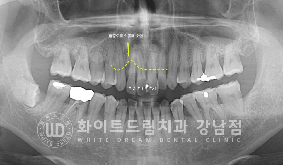 사고당한 앞니치료, "흔들리고 점점 변색돼요." 앞니 임플란트 & 신경치료 관련 이미지 4