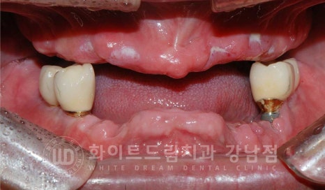 임플란트 재수술 잘하는치과 / 재수술과 전체 임플란트 치료를 동시에! 관련 이미지 14