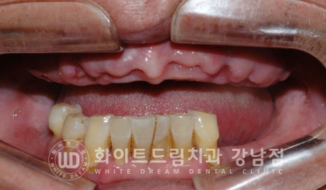 상악 풀케이스임플란트 사례 / "지인 추천으로 인천에서 왔어요." 관련 이미지 14