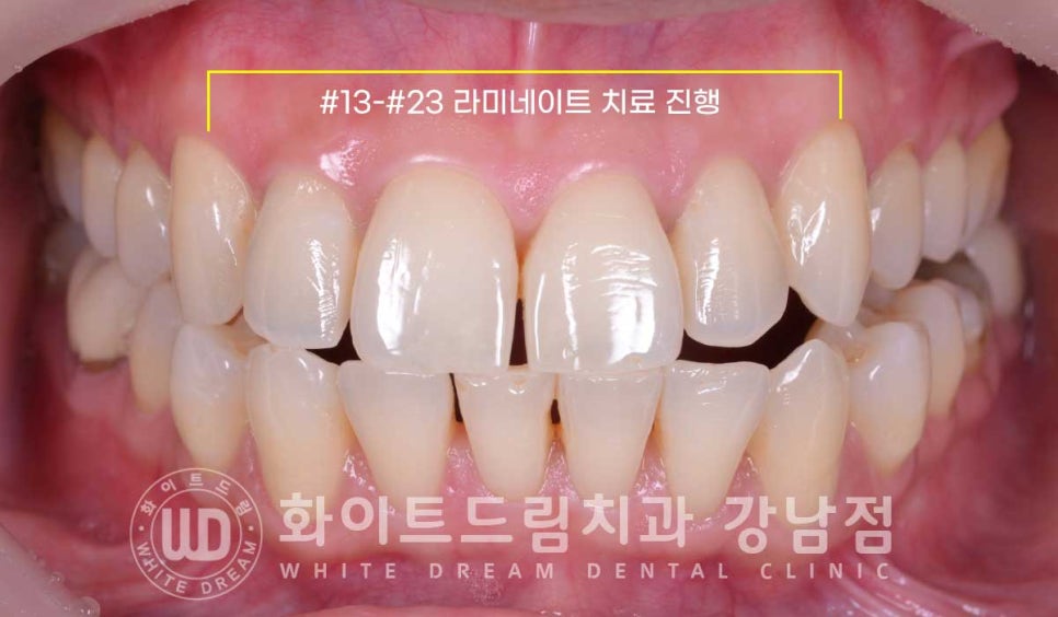 앞니 뻐드러짐 라미네이트 "뻐드러지고 벌어진 앞니" 당일 라미네이트 치료 case 관련 이미지 10