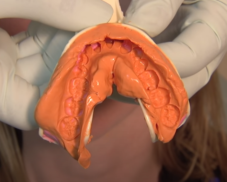 임플란트 하기 전 알아보아야 할 것. 관련 이미지 11