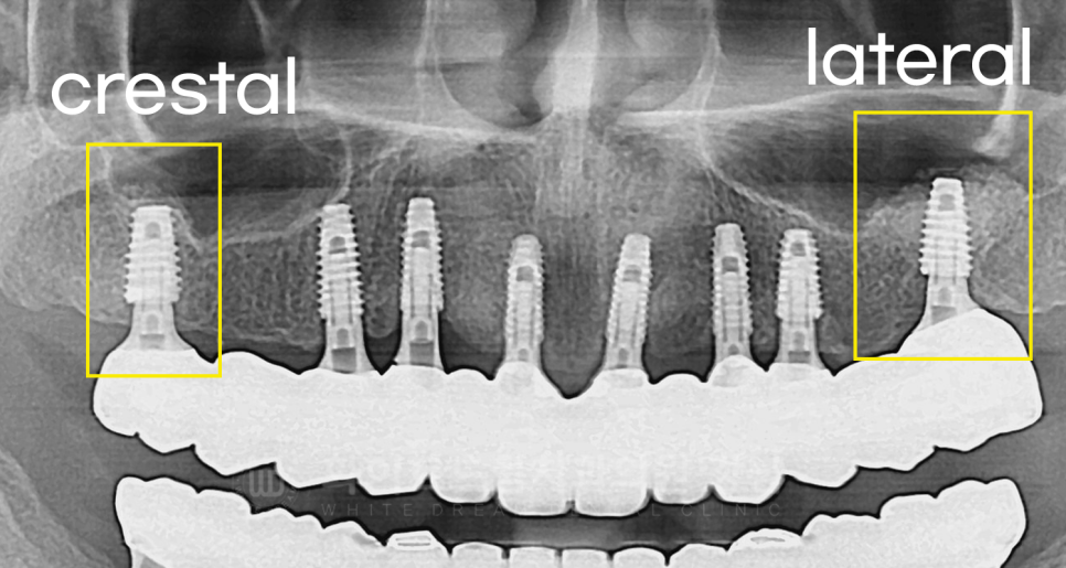 강남역 임플란트 치과 "틀니가 안 맞아서 불편해요" 틀니 → 전체 임플란트로! 관련 이미지 13