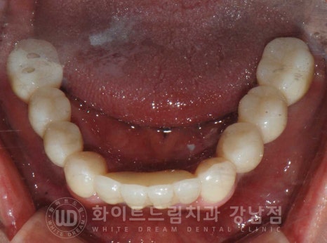 치주염 전체임플란트 치료 사례 / 치아를 흔들리게 만드는 치주염이란? 관련 이미지 14