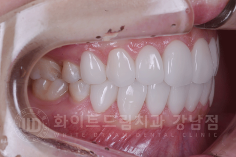 강남역 원데이 라미네이트 "유튜브 촬영하는데 치아가 신경 쓰여요" #강남화이트드림치과 관련 이미지 8