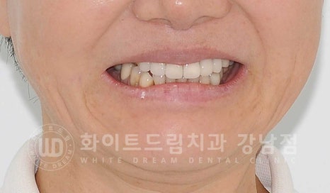 노화된 치아 라미네이트 / 치아미백을 해도 하얘지지 않는 마모된 치아는 어떻게 할까? 관련 이미지 6