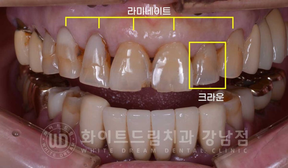 중년 앞니라미네이트 / 노화로 마모되고 누렇게 변한 치아, 어떻게 치료할까? 관련 이미지 11