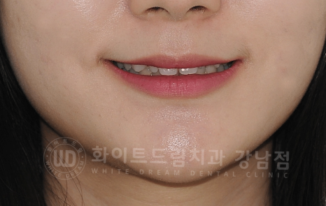 강남역 심미치과 "치아 하나가 유난히 작아요" #왜소치라미네이트 관련 이미지 11