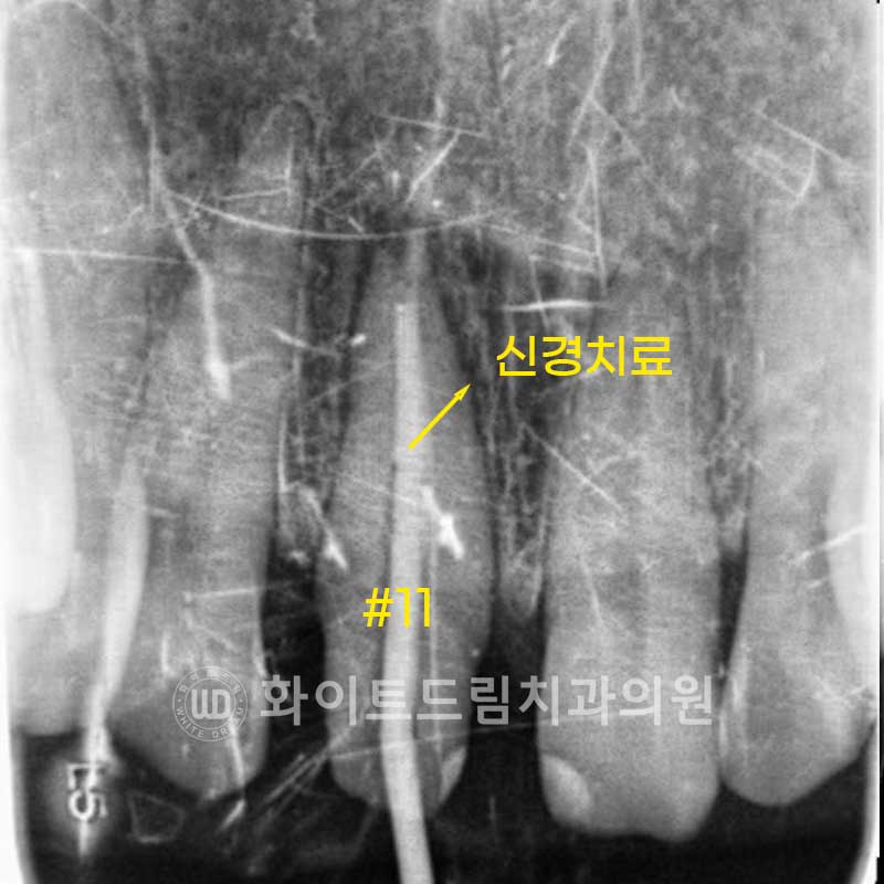 신논현라미네이트, 중년 충치치료, "치경부 우식증, 라미네이트로 당일 치료 OK" 관련 이미지 8