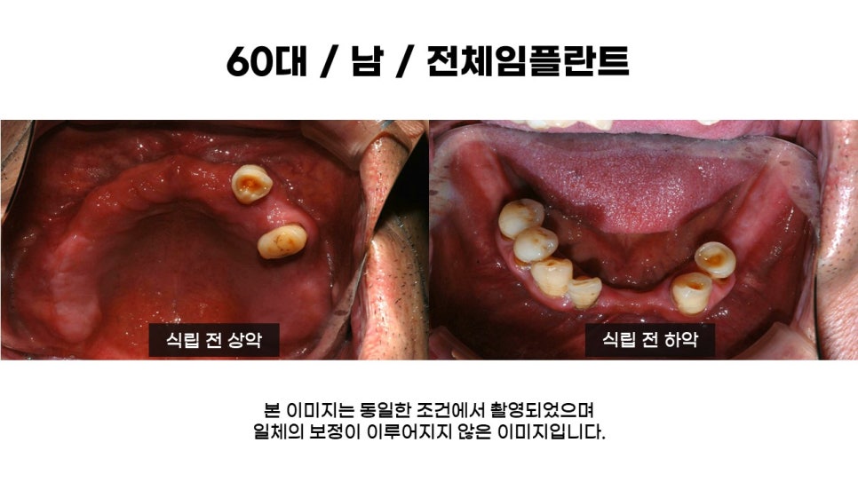 어금니임플란트 수복 및 당뇨환자임플란트 가격, 종류, 통증 관련 이미지 3