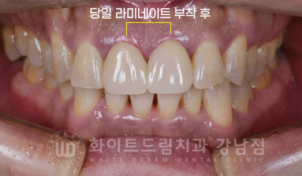 벌어지고 깨진 앞니, 웨딩 앞니 라미네이트 치료 사례 "남자도 자연스럽게 라미네이트 가능한가요?" 관련 이미지 13