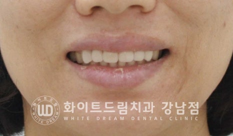 앞니 원데이라미네이트, 뻐드러지고 벌어진 앞니! 당일 치료 ok 관련 이미지 4