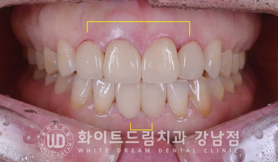 벌어진 앞니 라미네이트 / 50대 시니어 라미네이트 치료 사례 관련 이미지 8