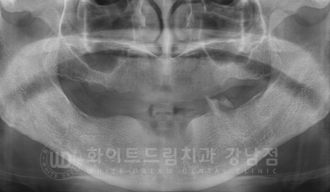 서울 전체임플란트 기간 / 전체 임플란트 7개월 완성, 무치악 임플란트 관련 이미지 2