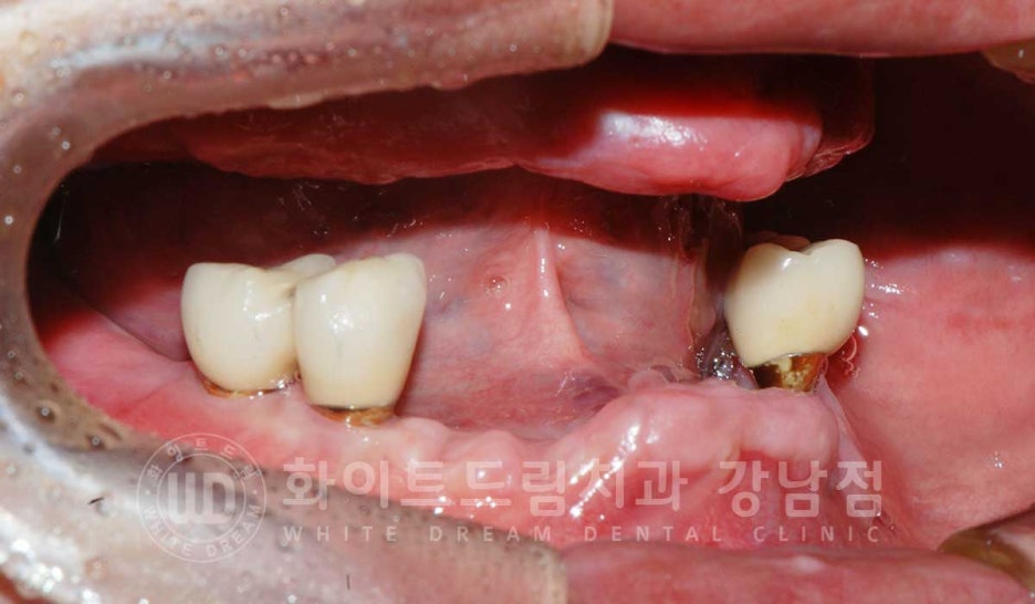 Gangnam Station Dental Clinic Specializing in Implant Revision Surgery—Revision Surgery and Full-Mouth Implant Treatment at the Same Time! image 3