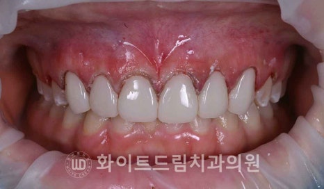강남역 잇몸성형, 라미네이트와 흔히 동반되는 관련 이미지 12