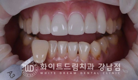 치경부착색 치료 / 라미네이트 vs 올세라믹 치아 삭제량 비교 (Feat. 라미네이트 후 치아미백 가능한가요?) 관련 이미지 15