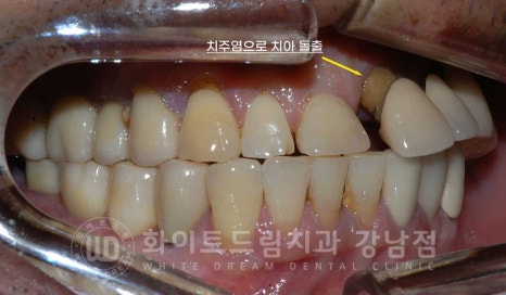 임플란트 재수술의 주원인, "임플란트 주위염과 임플란트 찢어짐!" 관련 이미지 8