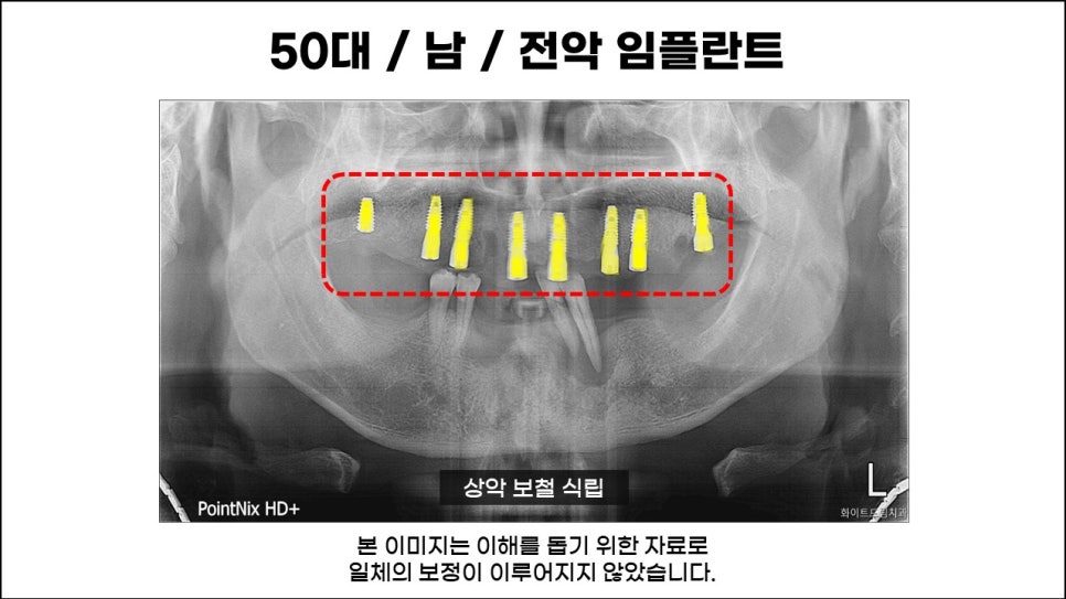 전체임플란트, 치료, 종류, 수술과정과 방법 관련 이미지 3
