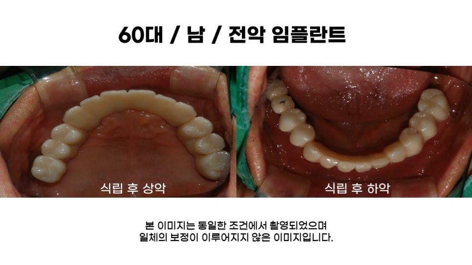 전악 임플란트 과정 및 후기 전후사례확인하고 임플란트가격 비용 알아보기 관련 이미지 5