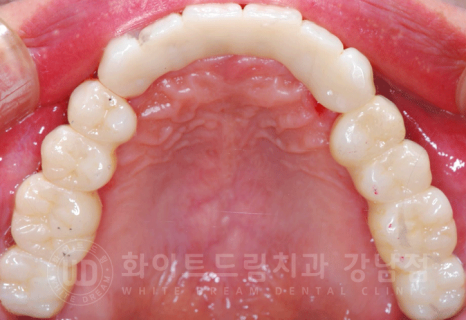 강남역 전체임플란트 치과 "치아가 심하게 흔들려요." 심한 치주염 임플란트 치료 관련 이미지 20