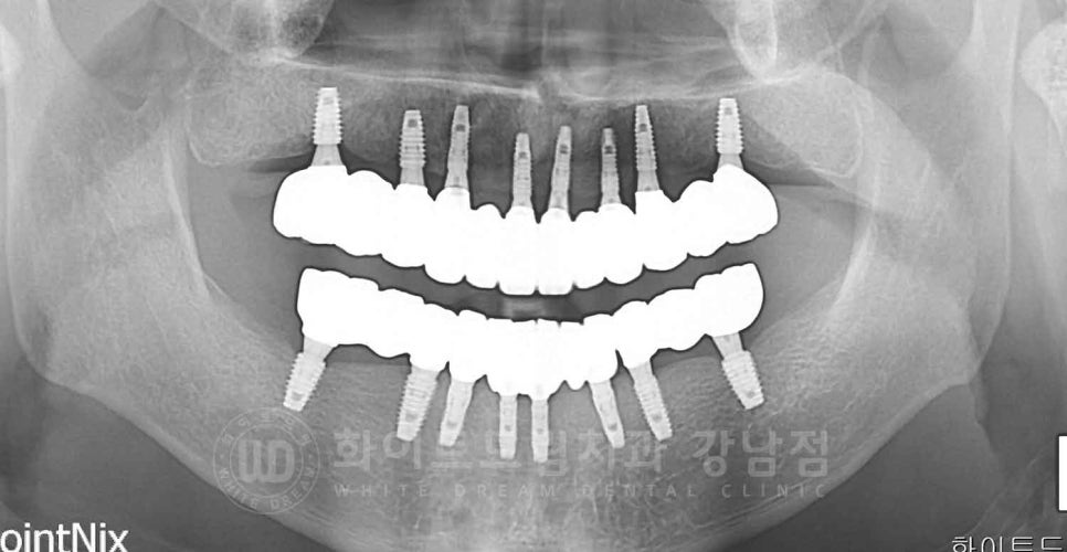 강남역 전악 임플란트 "치아가 흔들리고 빠져요!" 치주염 임플란트 치료 관련 이미지 9