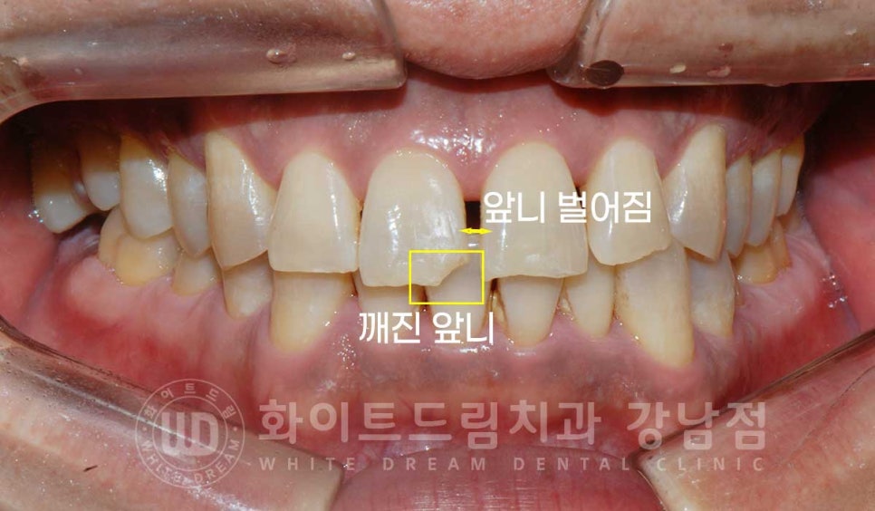 벌어지고 깨진 앞니, 웨딩 앞니 라미네이트 치료 사례 "남자도 자연스럽게 라미네이트 가능한가요?" 관련 이미지 6
