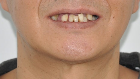 40대임플란트식립후기 및 어금니임플란트 가격, 종류 알아보기 위해 관련 이미지 20