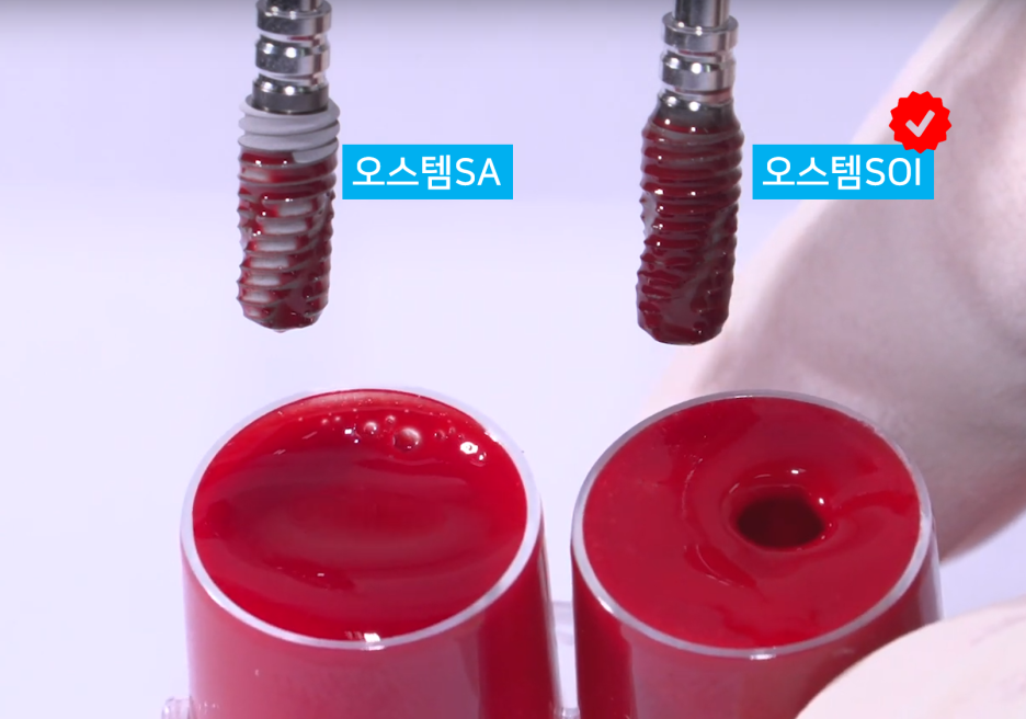 임플란트 하기 전 알아보아야 할 것. 관련 이미지 22