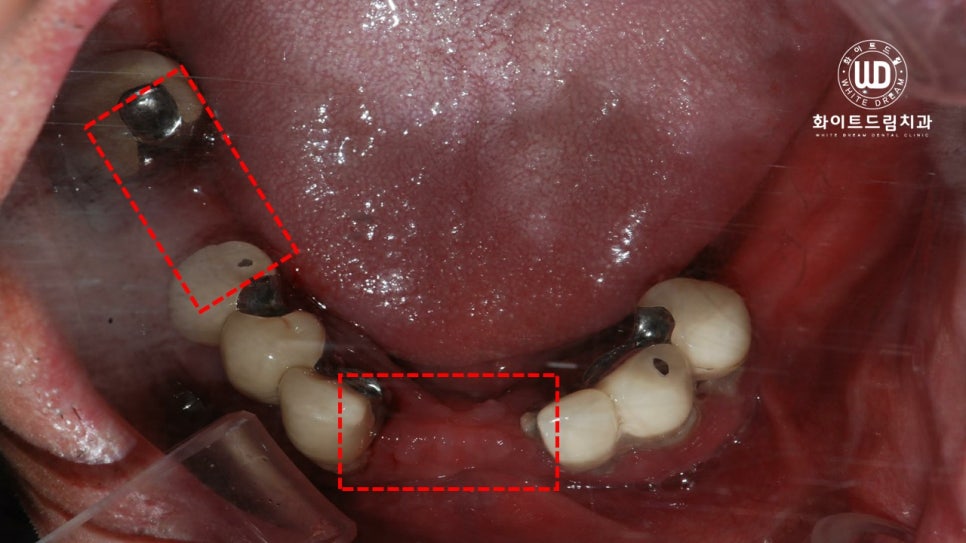 무너진 잇몸뼈와 치아 상실을 대체하는 전악임플란트 치료 사례 관련 이미지 2