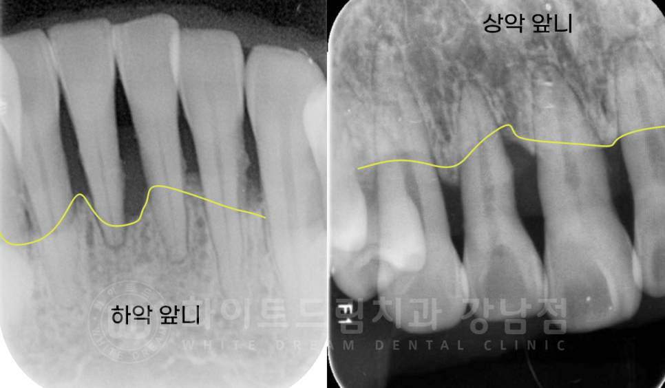 서초동 치과 추천 / "임플란트 개수를 줄이는 식립 방법은?" 강남 화이트드림치과 임플란트 관련 이미지 5