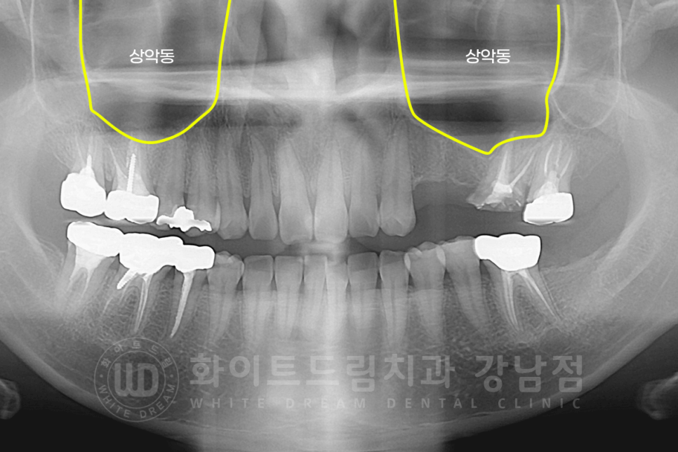 강남역 어금니 임플란트 "어금니가 부러졌어요" 상악동 거상술(lateral approach) 관련 이미지 2