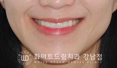 치경부착색 치료 / 라미네이트 vs 올세라믹 치아 삭제량 비교 (Feat. 라미네이트 후 치아미백 가능한가요?) 관련 이미지 11