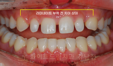 강남 벌어진앞니 교정 / "심하게 벌어진 치아, 어떻게?" 부분교정 + 라미네이트로 개선! 관련 이미지 12