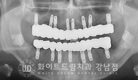 40대 전체임플란트 / 디지털스캔바디를 이용한 전체 임플란트 치료 사례 (Feat. 치주염) 관련 이미지 4