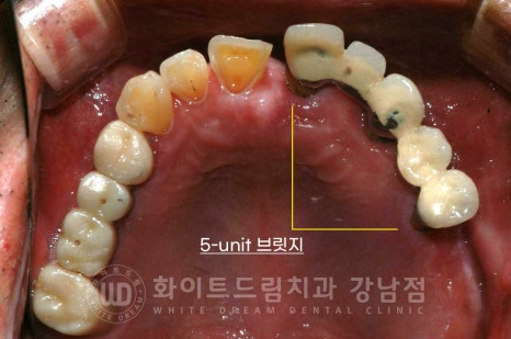 임플란트 재수술의 주원인, "임플란트 주위염과 임플란트 찢어짐!" 관련 이미지 5
