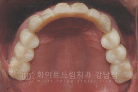 상악동거상술 잘하는치과, 강남역 화이트드림치과 상악동 함기화로 인한 거상술 치료 리뷰 관련 이미지 11